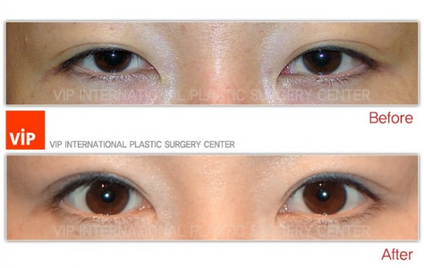 Eye Surgery - Phẫu thuật sa mí mắt