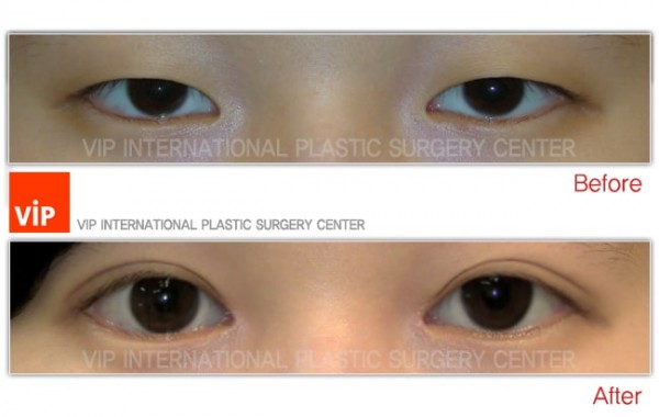 Eye Surgery - Phẫu thuật sa mí mắt