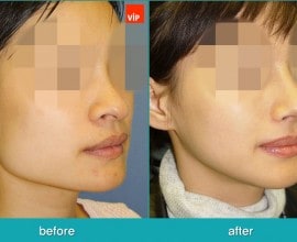 Nâng mũi bằng sụn sườn, Phẫu thuật tạo đường nét trên khuôn …