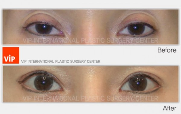 Eye Surgery - Phẫu thuật sa mí mắt