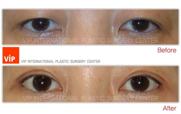 Eye Surgery - Phẫu thuật sa mí mắt