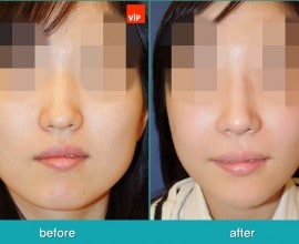 Nâng mũi bằng sụn vách ngăn, Phẫu thuật tạo đường nét trên k…