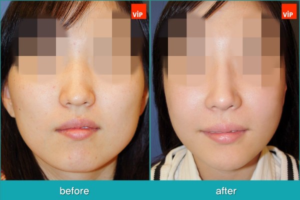 Nose Surgery - Nâng mũi bằng sụn vách ngăn, Phẫu thuật tạo đường nét trên khuôn mặt, Phẫu thuật gọt hàm, Phẫu thuật hạ gò má