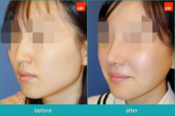 Nose Surgery - Nâng mũi bằng sụn vách ngăn, Phẫu thuật tạo đường nét trên khuôn mặt, Phẫu thuật gọt hàm, Phẫu thuật hạ gò má