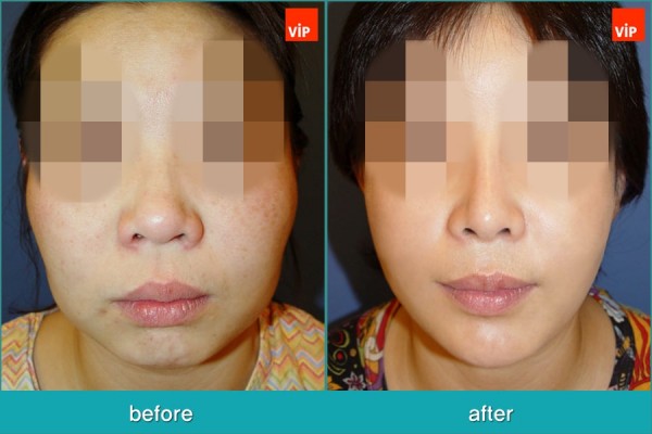 Nose Surgery, Facial Bone Surgery, Stem Cell Fat Graft - Nâng mũi bằng sụn sườn,  Phẫu thuật tạo đường nét trên khuôn mặt, Phẫu thuật gọt hàm, Hạ gò má, Cấy mỡ