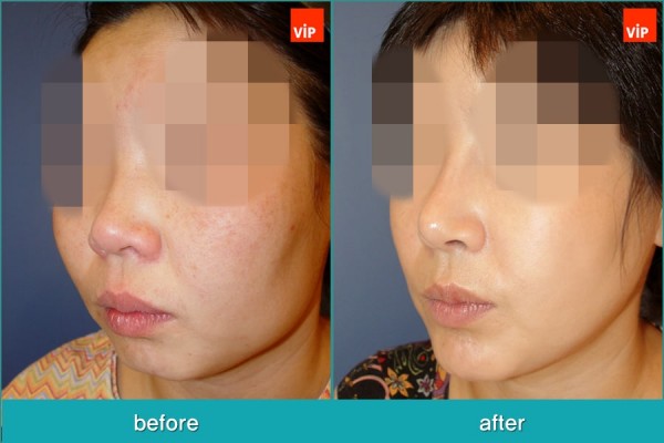 Nose Surgery, Facial Bone Surgery, Stem Cell Fat Graft - Nâng mũi bằng sụn sườn,  Phẫu thuật tạo đường nét trên khuôn mặt, Phẫu thuật gọt hàm, Hạ gò má, Cấy mỡ