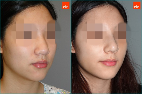 Nose Surgery - Nâng mũi bằng sụn sườn