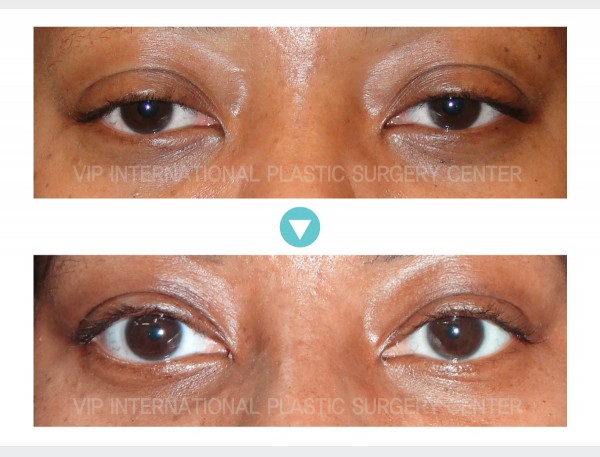 Eye Surgery - Phẫu thuật sa mí mắt