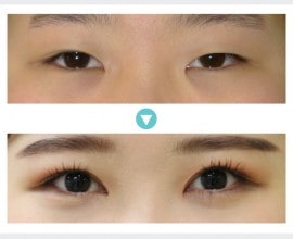 Phẫu thuật sa mí mắt