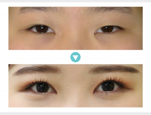 Eye Surgery - Phẫu thuật sa mí mắt