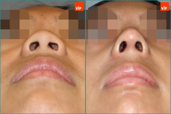 Nose Surgery - Nâng mũi bằng sụn sườn