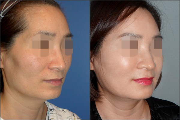 Stem Cell Fat Graft - Cấy mỡ