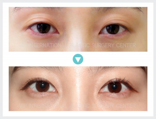 Eye Surgery - Phẫu thuật sa mí mắt