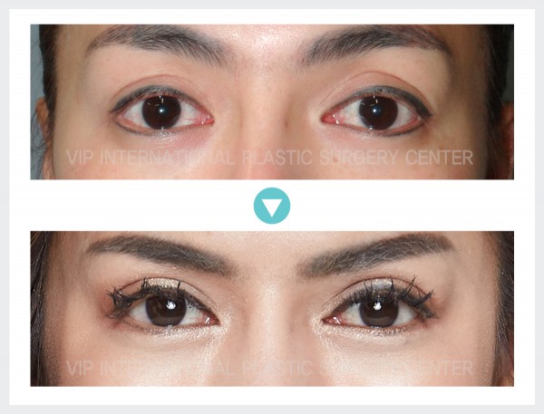 Eye Surgery - Phẫu thuật sa mí mắt