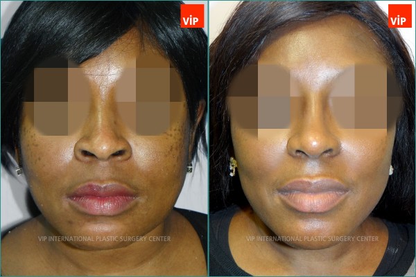 Nose Surgery - Chỉnh hình mũi lệch vách ngăn, Nâng vùng giữa mặt