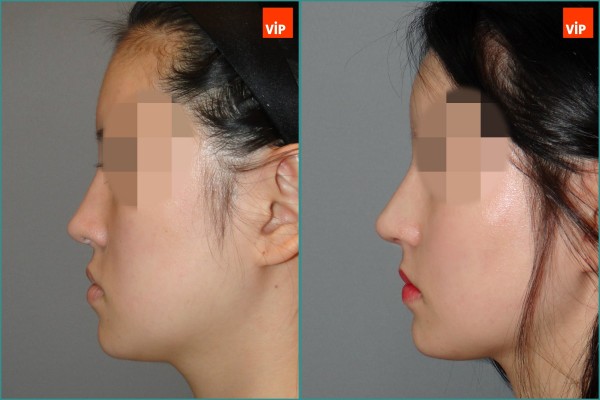 Nose Surgery - Nâng mũi bằng sụn sườn
