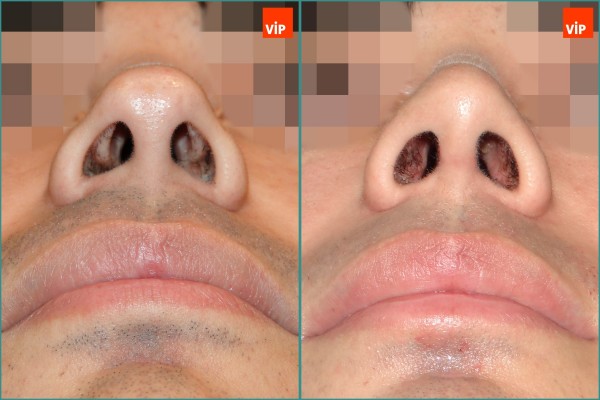 Nose Surgery - Nâng mũi bằng sụn vách ngăn (Mũi lệch vách ngăn)