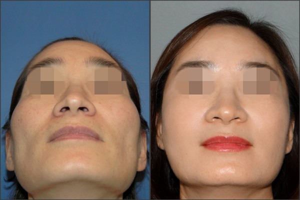 Stem Cell Fat Graft - Cấy mỡ