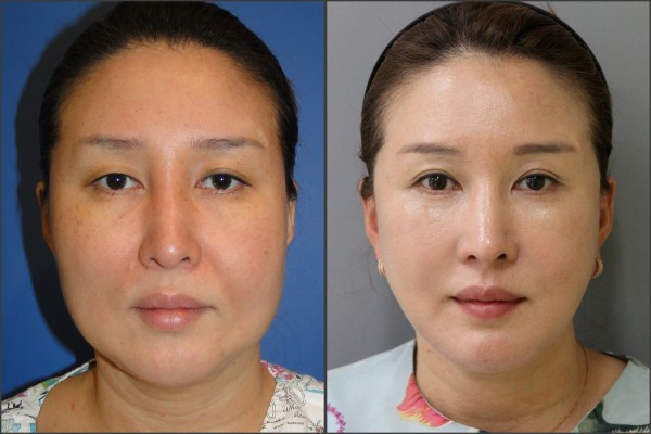 Nose Surgery, Face Lift - Nâng cơ mặt, Nâng mũi bằng sụn vách ngăn