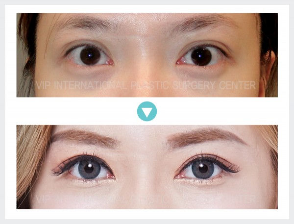 Eye Surgery - Phẫu thuật mắt hai mí