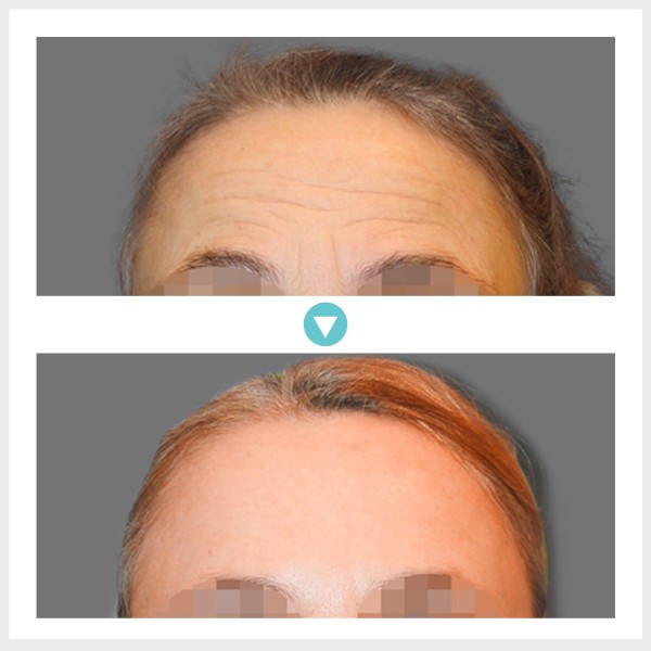 Face Lift - Phẫu thuật nâng trán nội soi