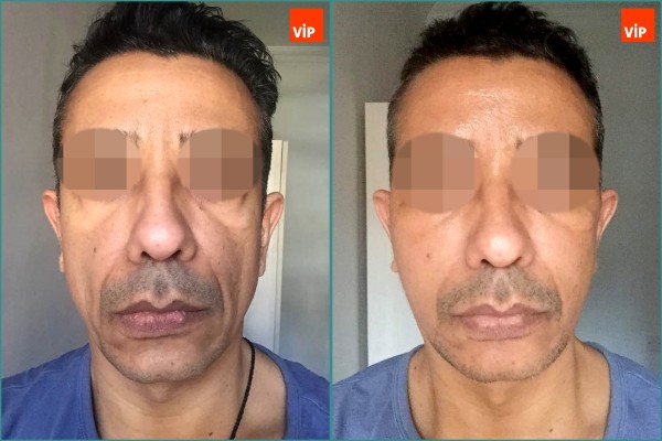 Face Lift - Nâng cơ mặt High-Smas