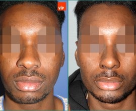 Nâng mũi bằng sụn sườn, Nâng trán, Phẫu thuật trượt cằm
