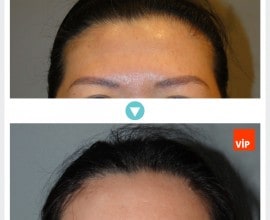 Phẫu thuật nâng trán