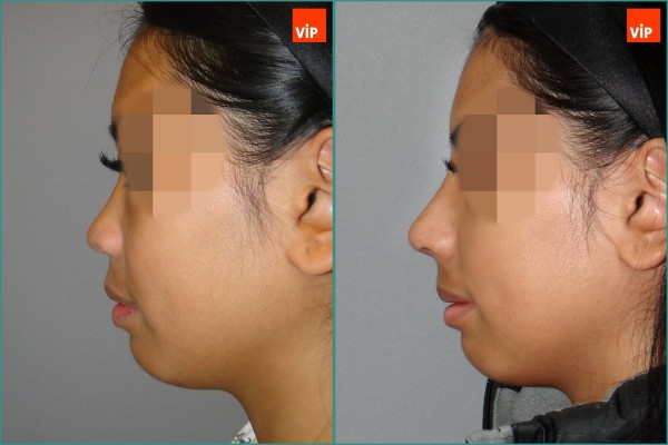 Nose Surgery - Nâng mũi bằng sụn sườn