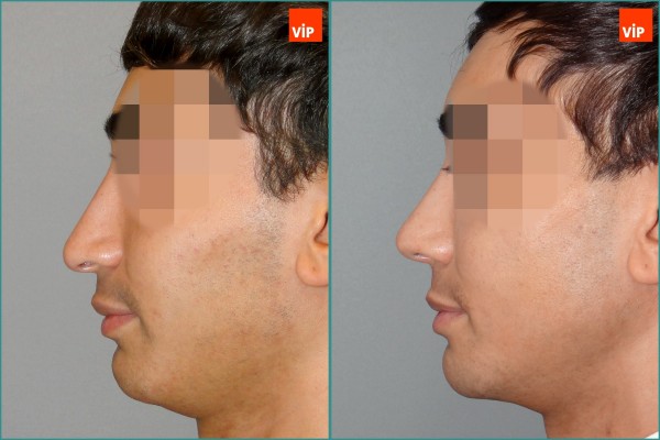 Nose Surgery - Nâng mũi bằng sụn vách ngăn (Mũi lệch vách ngăn)
