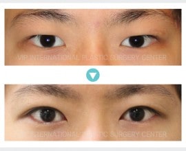 Phẫu thuật sa mí mắt