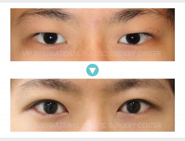 Eye Surgery - Phẫu thuật sa mí mắt