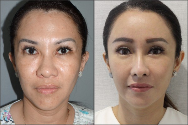 Nose Surgery, Eye Surgery, Face Lift, Stem Cell Fat Graft - Nâng mũi bằng sụn sườn, Nâng trán nội soi, Cấy mỡ, Mắt