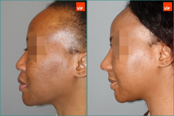Nose Surgery - Nâng mũi bằng sụn sườn, Nâng vùng giữa mặt