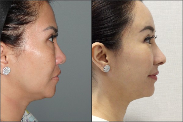 Nose Surgery, Eye Surgery, Face Lift, Stem Cell Fat Graft - Nâng mũi bằng sụn sườn, Nâng trán nội soi, Cấy mỡ, Mắt