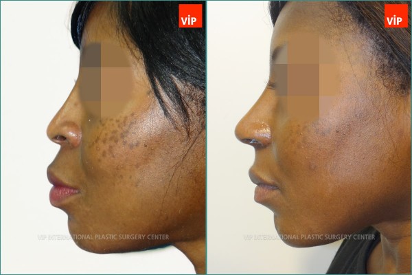 Nose Surgery - Chỉnh hình mũi lệch vách ngăn, Nâng vùng giữa mặt