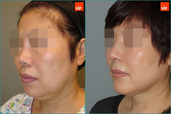 Nose Surgery, Face Lift - Nâng mũi bằng sụn sườn