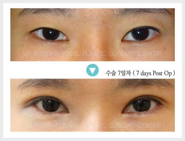 Eye Surgery - Phẫu thuật mắt hai mí