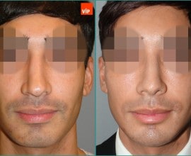 Nâng mũi bằng sụn vách ngăn (Mũi lệch vách ngăn)