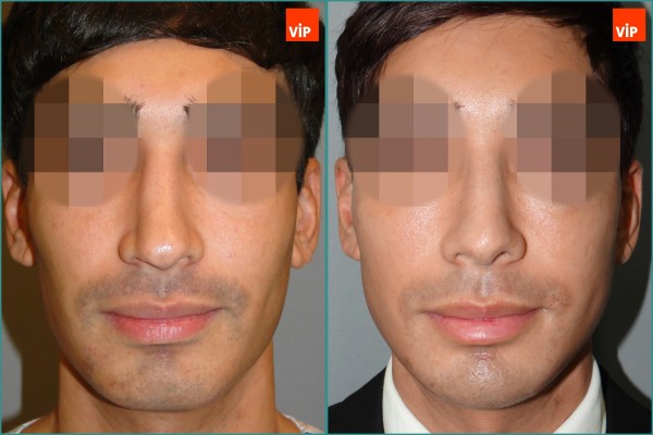 Nose Surgery - Nâng mũi bằng sụn vách ngăn (Mũi lệch vách ngăn)