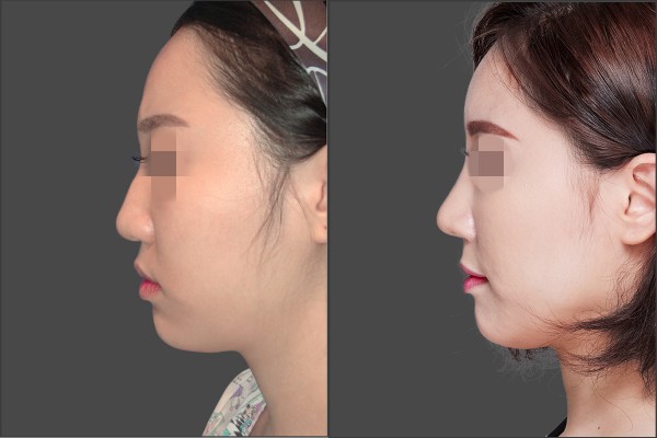 Nose Surgery, Stem Cell Fat Graft - Nâng mũi bằng sụn vách ngăn, Cấy mỡ