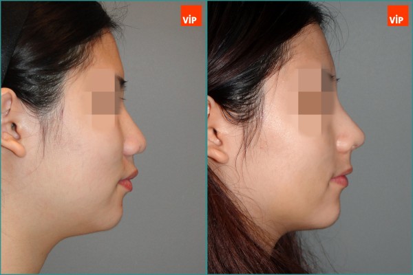 Nose Surgery - Nâng mũi bằng sụn sườn