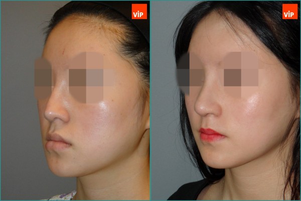 Nose Surgery - Nâng mũi bằng sụn sườn