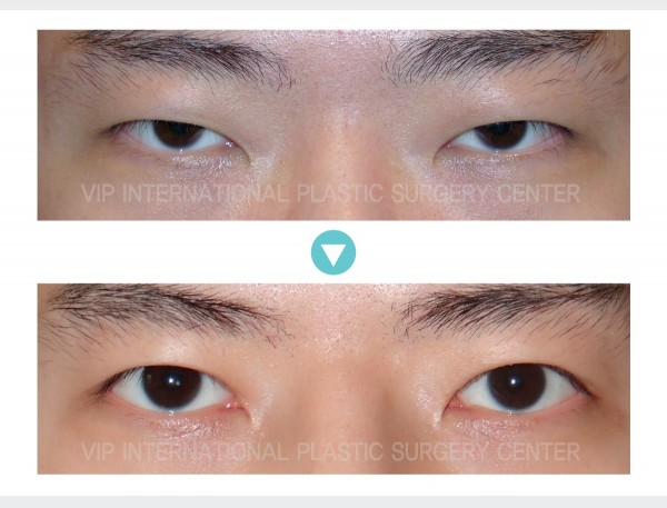 Eye Surgery - Phẫu thuật mắt hai mí