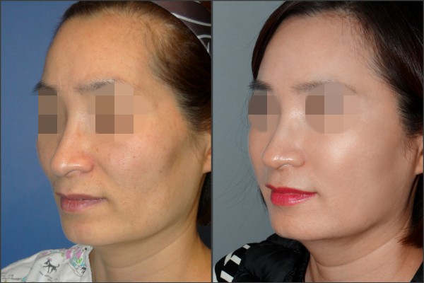 Stem Cell Fat Graft - Cấy mỡ