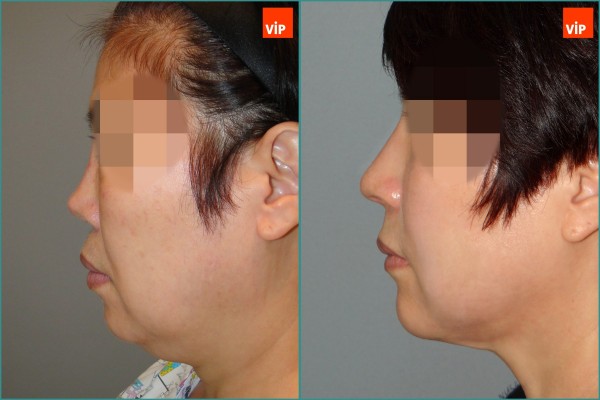 Nose Surgery, Face Lift - Nâng mũi bằng sụn sườn