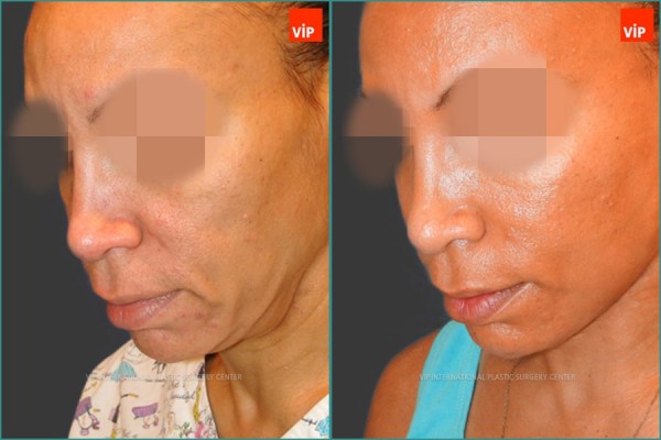 Face Lift - Nâng cổ High-Smas