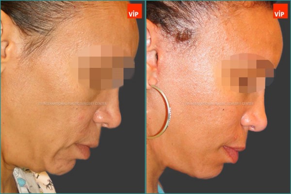 Face Lift - Nâng cổ High-Smas