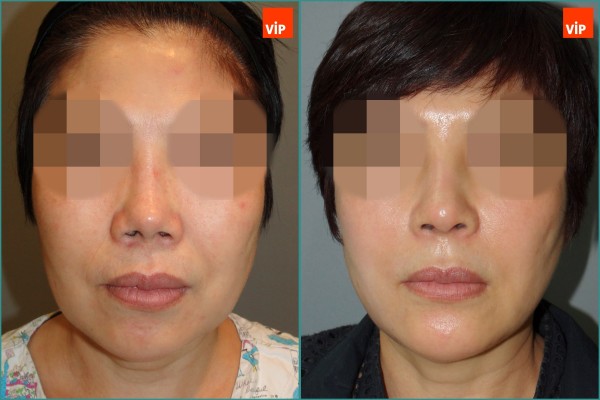 Nose Surgery, Face Lift - Nâng mũi bằng sụn sườn