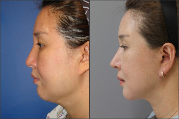 Nose Surgery, Face Lift - Nâng cơ mặt, Nâng mũi bằng sụn vách ngăn